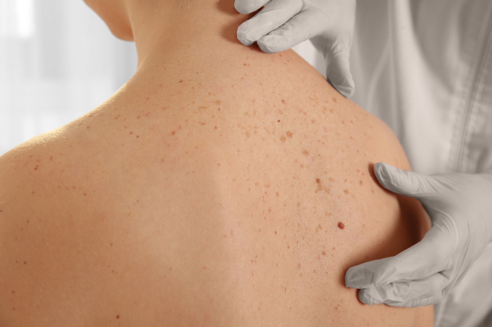 Una mancha en la piel podría ser melanoma: detectarlo a tiempo salva vidas